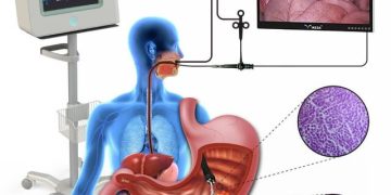 ساخت دستگاه تشخیص دقیق سرطان‌های دستگاه گوارش فوقانی